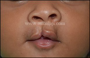 Incomplete Cleft Lip Defect In 3 Months Old Baby Girl
