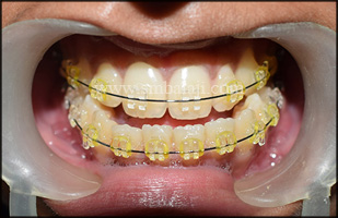 Intraoral View Showing Anterior Cross Bite Due To Forwardly Placed Lower Jaw