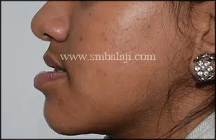 Pre-Operative Profile View Showing Reverse Alignment Of Lips Due To Long Lower Jaw Giving Asymmetric Profile