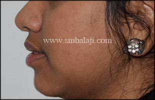 Post-Operative Profile View Showing Corrected Jaw Alignment Without Any Scars