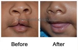 Incomplete cleft lip Before - After