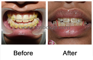 Long lower jaw corrected surgically enhancing the facial profile