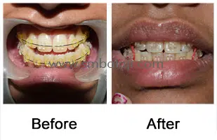 Long Lower Jaw Corrected Surgically Enhancing The Facial Profile