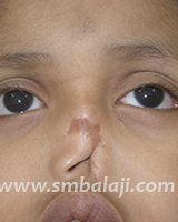 A Boy'S Nose Severely Injured In An Accident