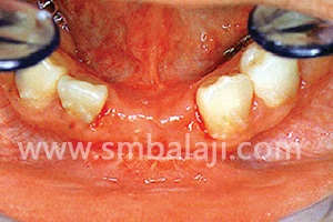 Distraction and Dental Implants 3 Adequate Bone Formation Following Distraction Osteogenesis