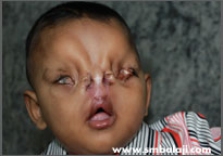 Face Reconstruction Surgery 2 After Cleft Lip And Palate Surgery