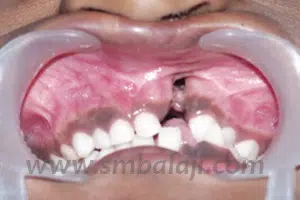 Alveolar (Tooth-Bearing Jaw Bone) Cleft