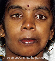 Hemifacial Microsomia 18 Asymmetry Of The Face Corrected With Distraction Osteogenesis Without Scars