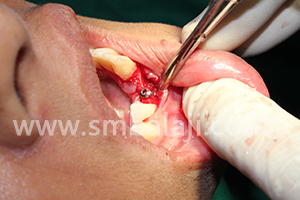 Bmp Inserted Adjacent To The Implant