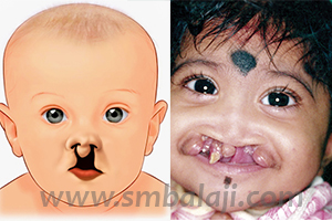 Bilateral Cleft Lip