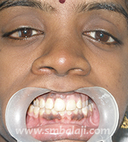 Hemifacial Microsomia 16 Bite Improved After Treatment