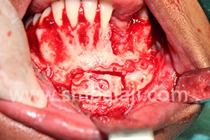 Bone Plates That Were Fixed To Treat The Jaw Bone Fracture Removed And Bone Graft Harvested