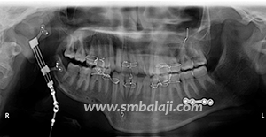 Bone Segments Moving Apart To Lengthen Bone