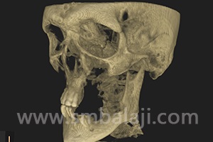 Cbct Scan Image Showing Very Thin Bone In Both Jaws