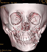 Ct Scan Image Showing Asymmetry Of Facial Skeleton