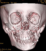 Hemifacial Microsomia 11 Ct Scan Image Showing Asymmetry Of Facial Skeleton