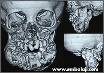 Tumor 3 Ct Scan Image Showing Tumour In Upper And Lower Jaw