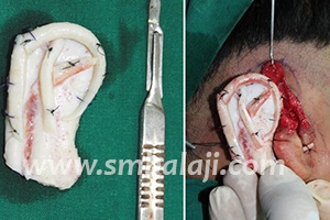 Cartilage graft from rip shaped to resemble ear Cartilage Graft From Rip Shaped To Resemble Ear