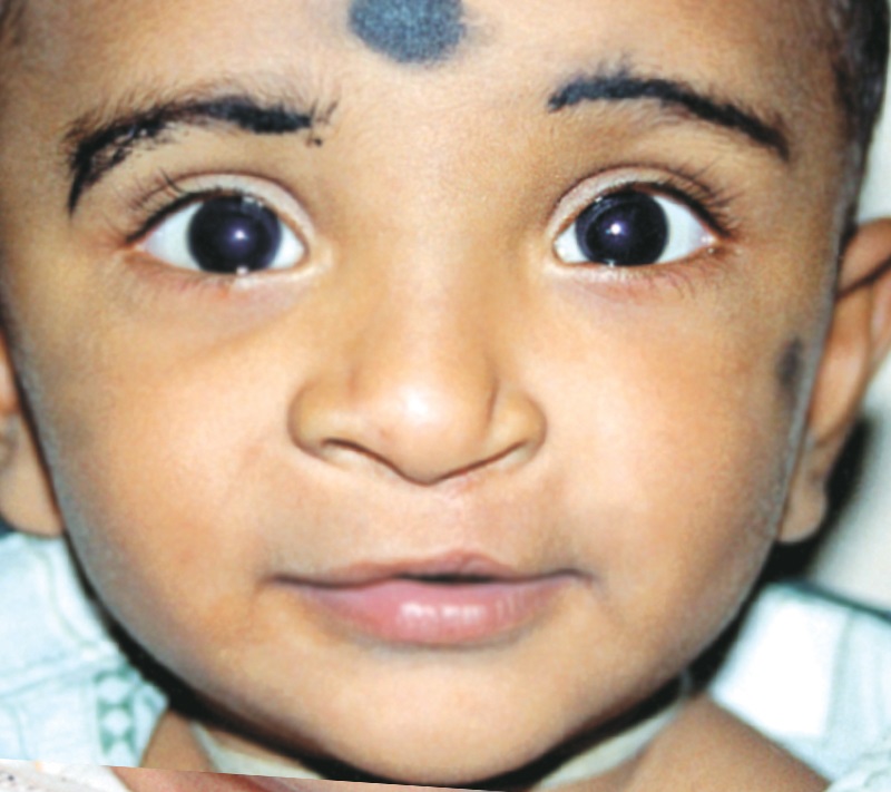 Treatment 4 Cleft Lip After