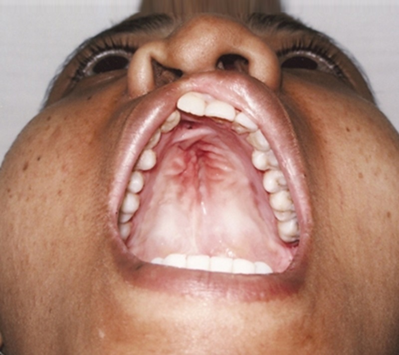 Treatment 8 Cleft Palate Repair After Picture