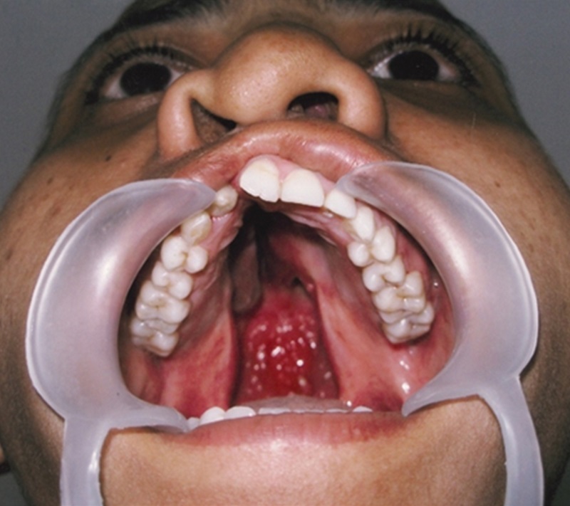 Treatment 7 Cleft Palate Repair Before Picture