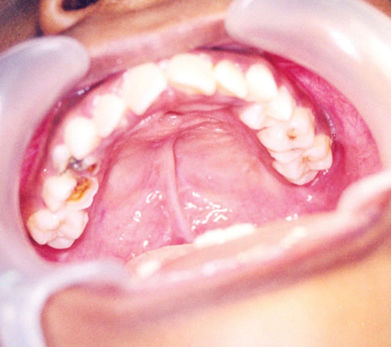 Cleft Palate Repair Surgery After Picture
