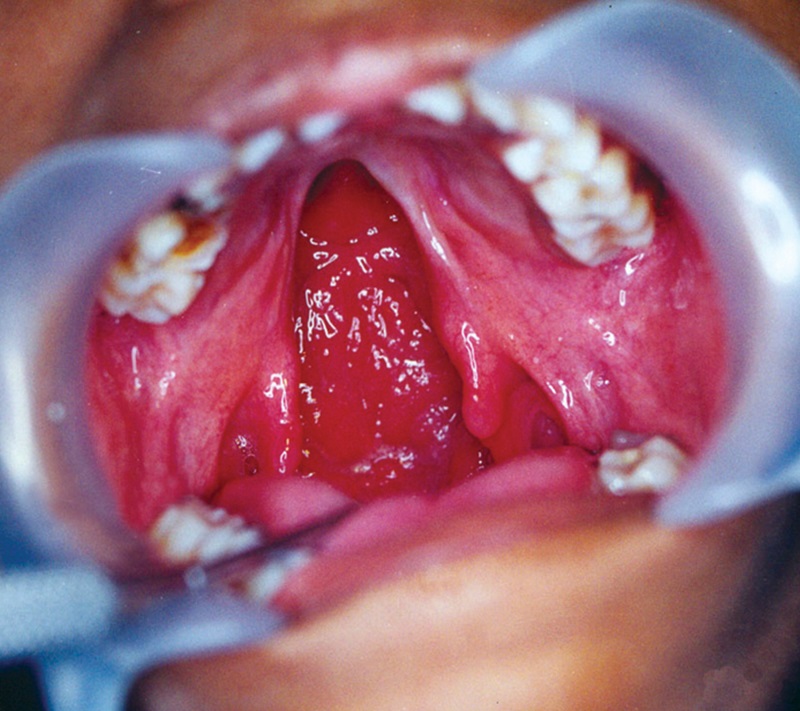 Treatment 5 Cleft Palate Repair Surgery Before Picture 1