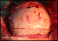 Craniotomy (Opening The Skull)