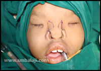 Craniofacial Deformities 13 Deficiency Of The Nose Is Corrected By Mobilizing The Tissues