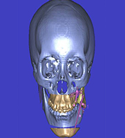 Hemifacial Microsomia 13 Distraction Osteogenesis Treatment Planning