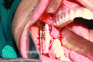 Distractor Device Fixed To Jaw Bone