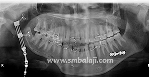 During Active Distraction Segmented Jaw Bone Pushed Apart &Amp; New Bone Formed In Resultant Gap