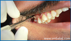 Tooth extractions or Exodontia 3 During Extraction- Accessing The Tooth From The Cheek Sid