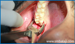Tooth extractions or Exodontia 5 During Extraction- Grasping The Tooth With Forceps