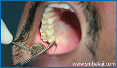 Tooth extractions or Exodontia 4 During Extraction- Accessing The Tooth From The Tongue Side