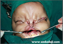 During Surgery, Reconstructing The Roof Of The Mouth And Upper Lip, Enabling The Child To Breathe And Eat Normally