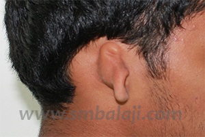 Ear Deformity- Microtia, Before Surgery