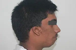 Ear Deformity In Patient With Hemifacial Microsomia
