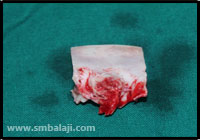 Craniofacial Deformities 12 Excess Bone Removed