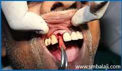 Tooth extractions or Exodontia 1 Exodontia Or Tooth Extraction