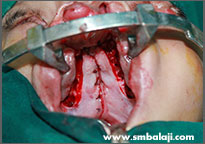 During Surgery, Reconstructing The Roof Of The Mouth And Upper Lip, Enabling The Child To Breathe And Eat Normally
