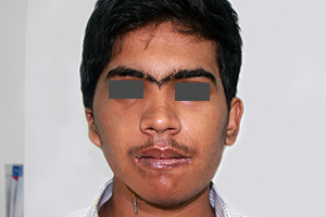 Facial Asymmetry Corrected With Distraction Osteogenesis