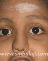 Nose Reconstruction Surgery 9 Few Days After Nose Reconstruction Surgery