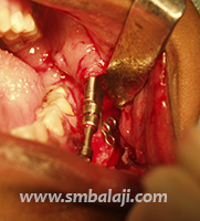 Fixing The Intraoral Distractor During Surgery