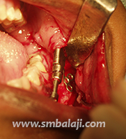 Hemifacial Microsomia 15 Fixing The Intraoral Distractor During Surgery