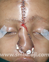 Forehead Flap Used For Nose Reconstruction