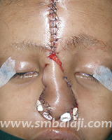 Nose Reconstruction Surgery 8 Forehead Flap Used For Nose Reconstruction