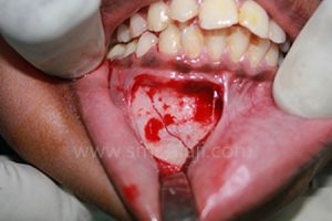 Fracture Of The Lower Jaw