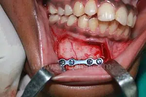 Fractured Bone Stabilized Using Bone Plate