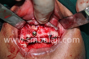 Harvested Graft Used To Strengthen Bone In The Upper Jaw